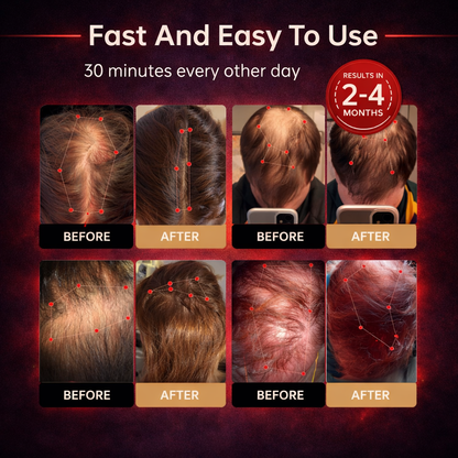 🔥Last Day:40% off 🔥Red Light Therapy Regrowth Cap